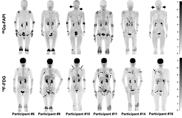 Study on Value of 68Ga-FAPI PET/CT Imaging for Evaluation of